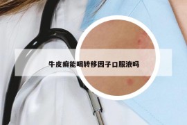 牛皮癬能喝轉(zhuǎn)移因子口服液嗎