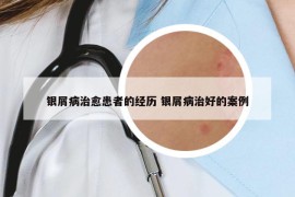 銀屑病治愈患者的經(jīng)歷 銀屑病治好的案例