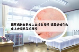 銀屑病長(zhǎng)在頭皮上會(huì)掉頭發(fā)嗎 銀屑病長(zhǎng)在頭皮上會(huì)掉頭發(fā)嗎圖片
