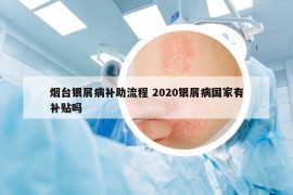 煙臺銀屑病補助流程 2020銀屑病國家有補貼嗎