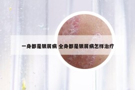 一身都是銀屑病 全身都是銀屑病怎樣治療