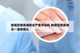 膿皰型銀屑病脫皮嚴(yán)重傳染嗎 膿皰型銀屑病會(huì)一直膿皰么