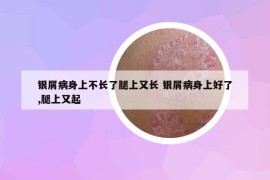 銀屑病身上不長了腿上又長 銀屑病身上好了,腿上又起
