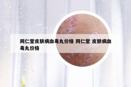 同仁堂皮膚病血毒丸價格 同仁堂 皮膚病血毒丸價格
