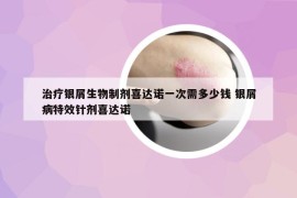 治療銀屑生物制劑喜達(dá)諾一次需多少錢(qián) 銀屑病特效針劑喜達(dá)諾