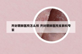 開(kāi)封朝鮮醫(yī)院怎么樣 開(kāi)封朝鮮醫(yī)院皮膚科專家