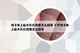 孩子身上起大片紅疙瘩怎么回事 十歲孩子身上起大片紅疙瘩怎么回事