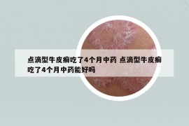 點滴型牛皮癬吃了4個月中藥 點滴型牛皮癬吃了4個月中藥能好嗎