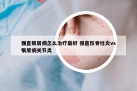 強(qiáng)直銀屑病怎么治療最好 強(qiáng)直性脊柱炎vs銀屑病關(guān)節(jié)炎