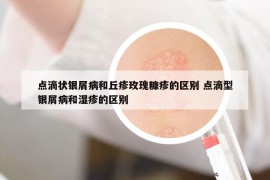 點(diǎn)滴狀銀屑病和丘疹玫瑰糠疹的區(qū)別 點(diǎn)滴型銀屑病和濕疹的區(qū)別