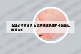 白斑的初期癥狀 白斑初期癥狀圖片小孩是從哪里來的