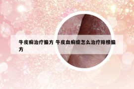 牛皮癬治療偏方 牛皮血癬癥怎么治療除根偏方