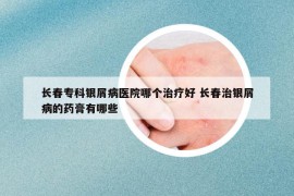 長春專科銀屑病醫(yī)院哪個治療好 長春治銀屑病的藥膏有哪些