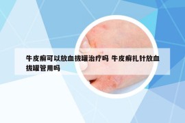 牛皮癬可以放血拔罐治療嗎 牛皮癬扎針放血拔罐管用嗎