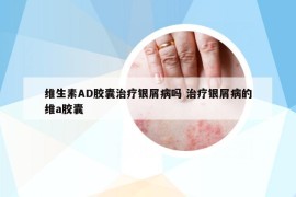維生素AD膠囊治療銀屑病嗎 治療銀屑病的維a膠囊