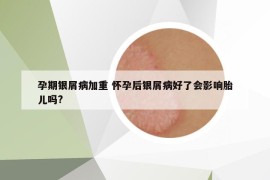 孕期銀屑病加重 懷孕后銀屑病好了會(huì)影響胎兒?jiǎn)?