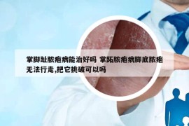 掌腳趾膿皰病能治好嗎 掌跖膿皰病腳底膿皰無法行走,把它挑破可以嗎