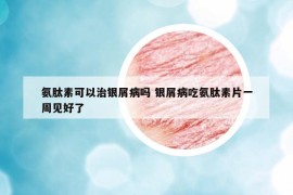 氨肽素可以治銀屑病嗎 銀屑病吃氨肽素片一周見好了