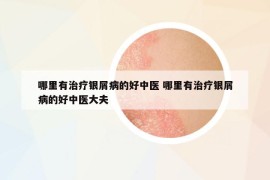 哪里有治療銀屑病的好中醫(yī) 哪里有治療銀屑病的好中醫(yī)大夫
