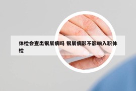 體檢會(huì)查出銀屑病嗎 銀屑病影不影響入職體檢