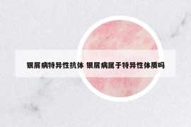 銀屑病特異性抗體 銀屑病屬于特異性體質(zhì)嗎