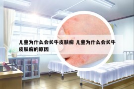 兒童為什么會(huì)長(zhǎng)牛皮膚癬 兒童為什么會(huì)長(zhǎng)牛皮膚癬的原因