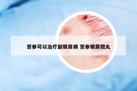 苦參可以治療副銀屑病 苦參銀屑膠丸