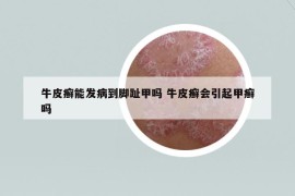 牛皮癬能發(fā)病到腳趾甲嗎 牛皮癬會引起甲癬嗎