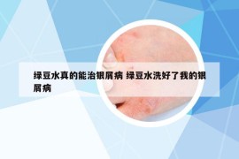 綠豆水真的能治銀屑病 綠豆水洗好了我的銀屑病