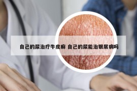 自己的尿治療牛皮癬 自己的尿能治銀屑病嗎