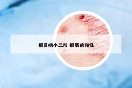銀屑病小三陽 銀屑病陽性