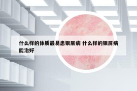 什么樣的體質(zhì)最易患銀屑病 什么樣的銀屑病能治好