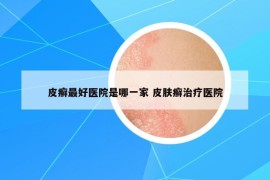 皮癬最好醫(yī)院是哪一家 皮膚癬治療醫(yī)院