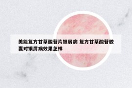 美能復(fù)方甘草酸苷片銀屑病 復(fù)方甘草酸苷膠囊對(duì)銀屑病效果怎樣