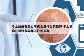 手上長癬有裂口不愈合用什么藥最好 手上長癬開裂好多年都不好怎么辦