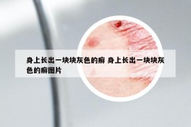 身上長出一塊塊灰色的癬 身上長出一塊塊灰色的癬圖片