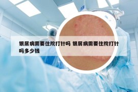 銀屑病需要住院打針嗎 銀屑病需要住院打針嗎多少錢