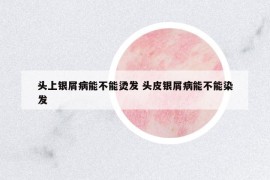 頭上銀屑病能不能燙發(fā) 頭皮銀屑病能不能染發(fā)