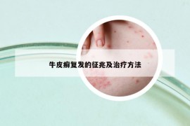 牛皮癬復(fù)發(fā)的征兆及治療方法