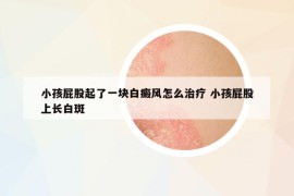 小孩屁股起了一塊白癜風(fēng)怎么治療 小孩屁股上長(zhǎng)白斑