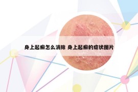 身上起癬怎么消除 身上起癬的癥狀圖片