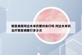 銀屑病用阿達木單抗要終身打嗎 阿達木單抗治療銀屑病要打多少次