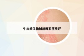 牛皮癬生物制劑哪家醫(yī)院好