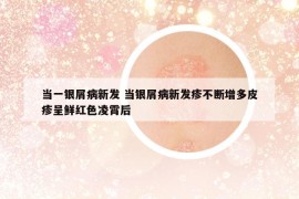 當(dāng)一銀屑病新發(fā) 當(dāng)銀屑病新發(fā)疹不斷增多皮疹呈鮮紅色凌霄后