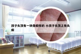 孩子頭頂有一塊像癬樣的 小孩子頭頂上有頭癬