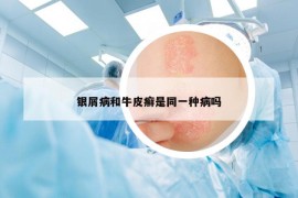 銀屑病和牛皮癬是同一種病嗎