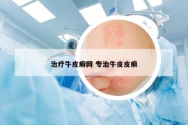 治療牛皮癬網(wǎng) 專治牛皮皮癬