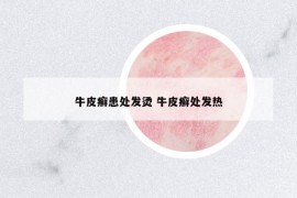 牛皮癬患處發(fā)燙 牛皮癬處發(fā)熱