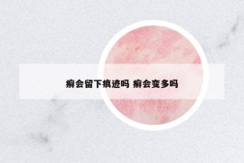 癬會(huì)留下痕跡嗎 癬會(huì)變多嗎