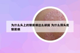 為什么頭上的銀屑病這么頑固 為什么得頭皮銀屑病